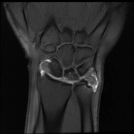 triangular fibrocartilage complex tear mri